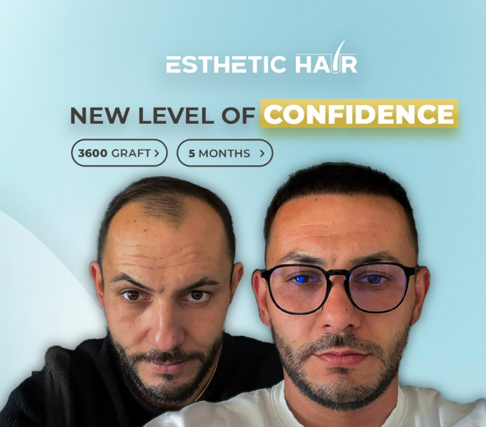 Hair Transplant - DHI Technique